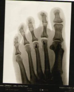 Skeleton Foot 241x300